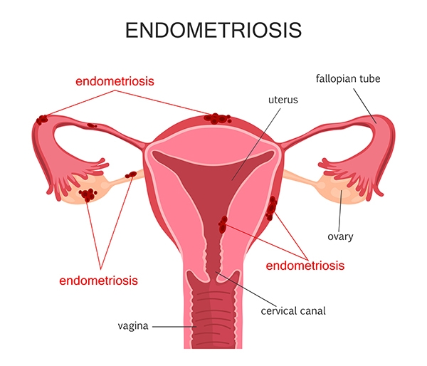 Endometriosis Treatment: An Ayurvedic Approach 
