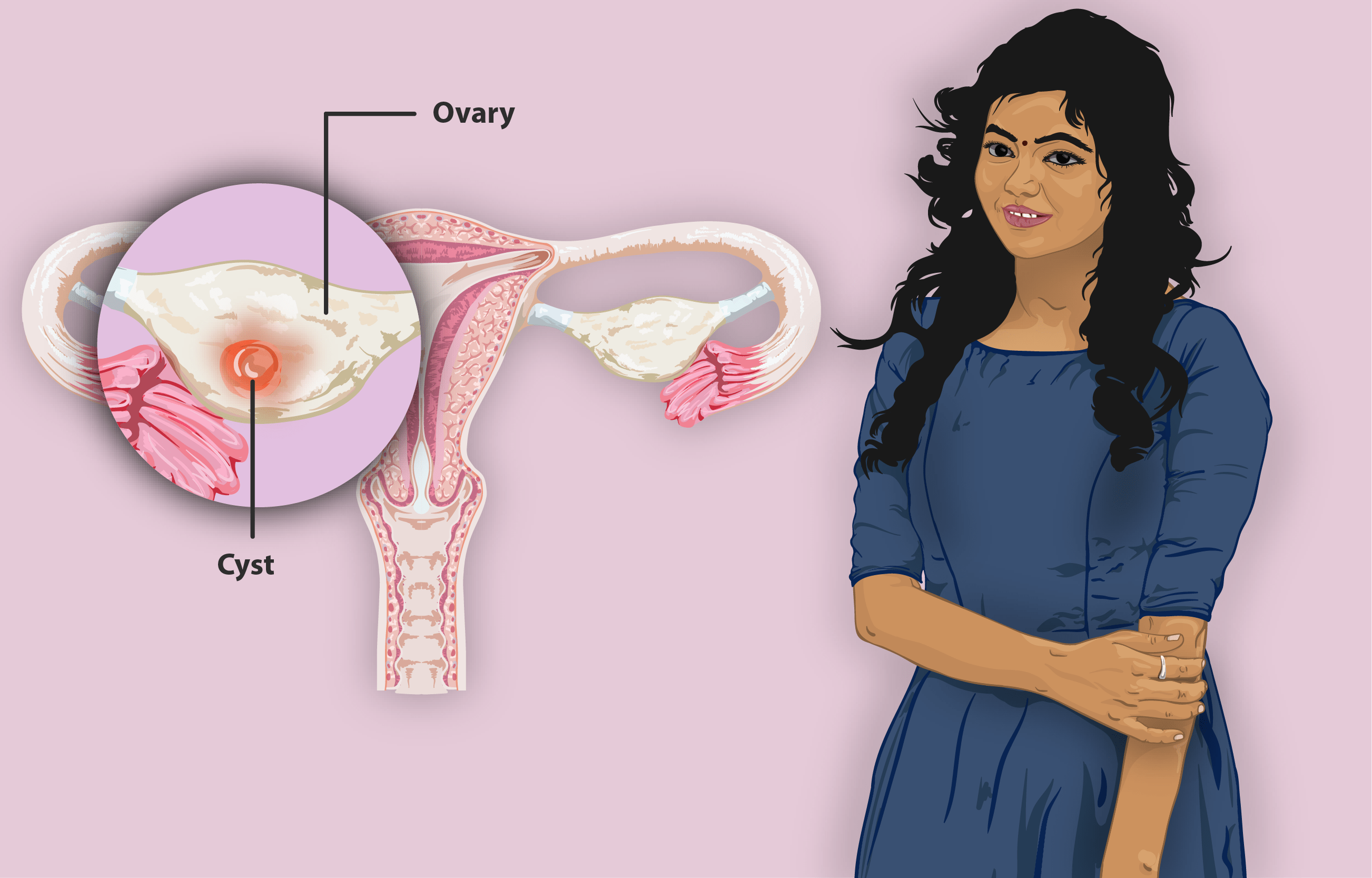 Ayurvedic Approaches to Ovarian Cyst Treatment in Delhi 